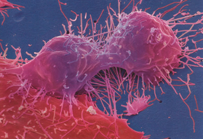 Клетка раковой опухоли фото