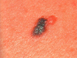Рак кожи (Меланома) фото 