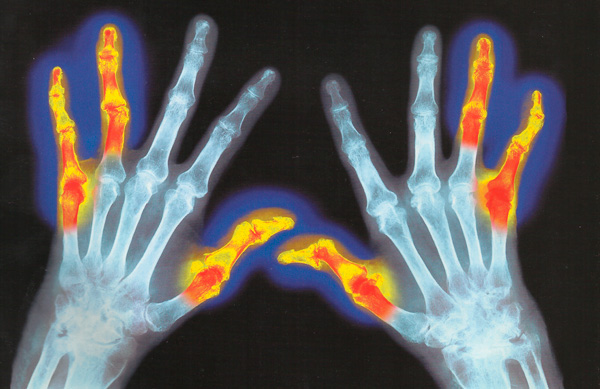 рентгенограмма рук