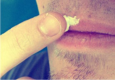 Чем лечить герпес на губах? Народые советы