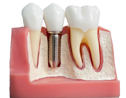 Процесс протезирования зубов