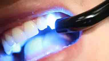 виды зубных пломб